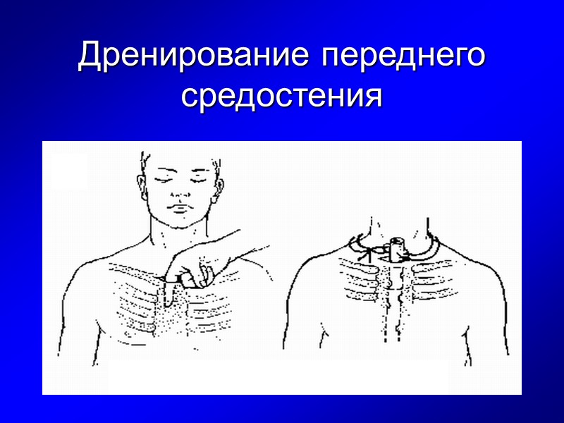 Дренирование переднего средостения